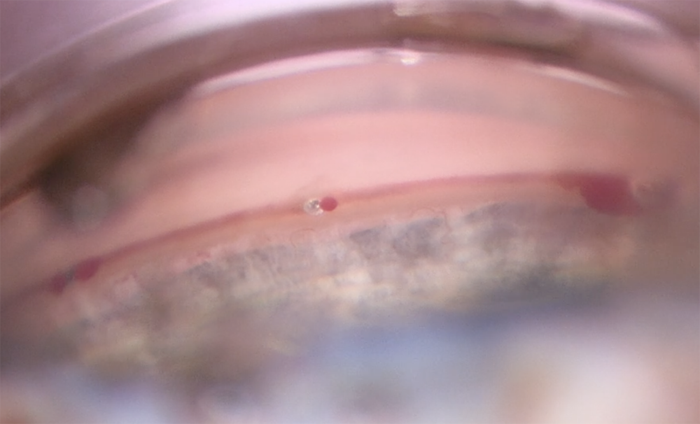 iStent infinite in the canal with reflux of heme
Source: Inder Paul Singh, MD