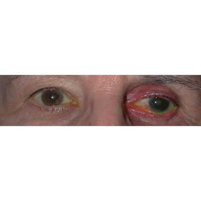 Read more about the article Where drops fit in the interventional glaucoma era