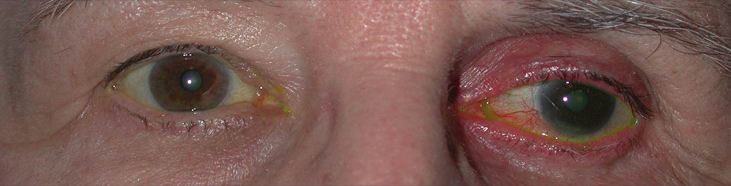 Dr. Bacharach’s minimal instillation drop strategy (MIDS); OD: post-streamlining, post-SLT on q daily monotherapy; OS: still on multiple generic preserved agents (five drop applications per day)
Source: Jason Bacharach, MD