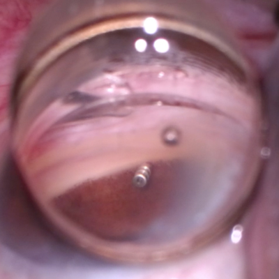 Read more about the article Next stop for glaucoma medications: sustained drug delivery