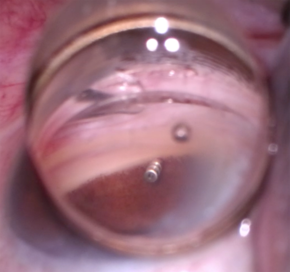 Intraoperative view of iDose TR in the left eye of a patient Source: Jacob Brubaker, MD