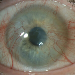 Read more about the article BrightMEM corneal allograft: a new treatment for ocular surface disease