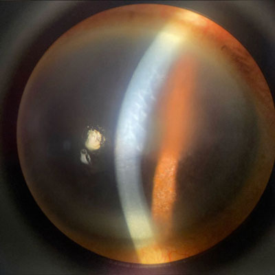 Read more about the article The conundrum of prolonged post-cataract corneal edema