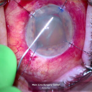 Read more about the article The iris prolapsed—don’t panic