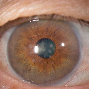 Read more about the article Handling opacified corneas when cataract surgery is needed