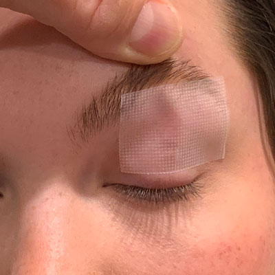 Read more about the article Tarsorrhaphy: the cornea’s best friend