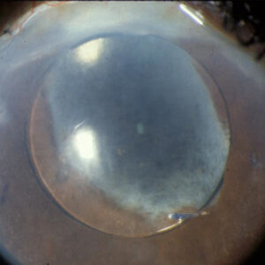 Read more about the article Considerations for uveitis and cataract surgery