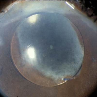 Read more about the article Considerations for uveitis and cataract surgery