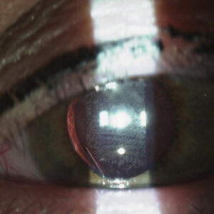 Read more about the article Opinions on lens materials: hydrophobic, hydrophilic, silicone, and more