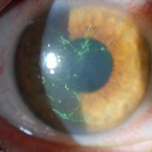 Read more about the article Highlighting results from the Zoster Eye Disease Study (ZEDS)