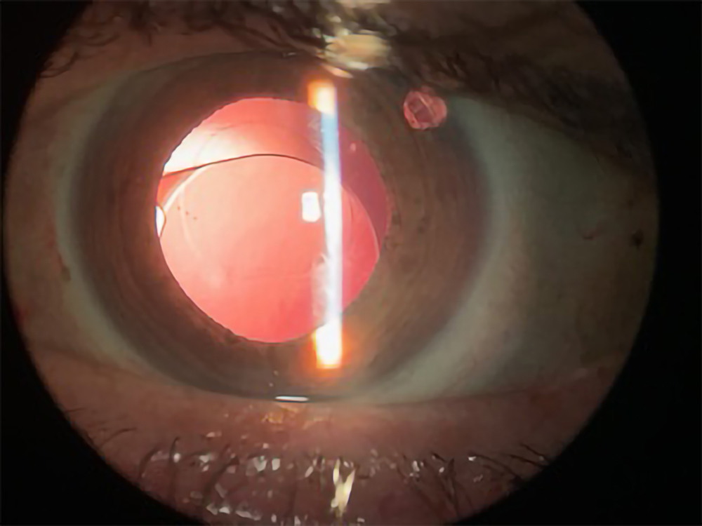 Single-piece IOL dislocation within the bag due to dead bag 
syndrome
Source: John Hart Jr., MD