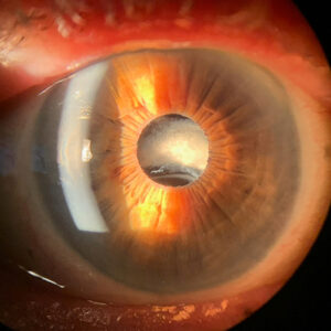 Read more about the article Secondary IOL fixation: when to use, techniques, and other considerations