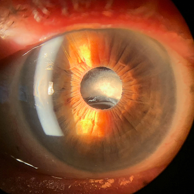 Secondary IOL fixation: when to use, techniques, and other