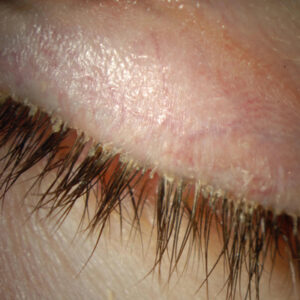 Read more about the article Updates expected for the ASCRS Preoperative OSD Algorithm