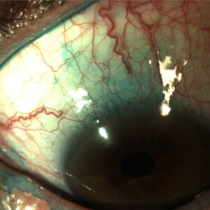 Read more about the article Dry eye decoys: don’t be fooled