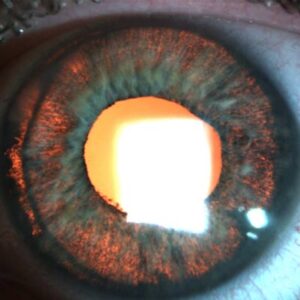 Read more about the article Piggyback IOLs an important tool for postop precision