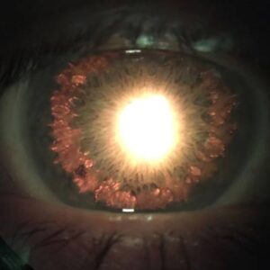 Read more about the article Pigment dispersion syndrome and pigmentary glaucoma: the basics