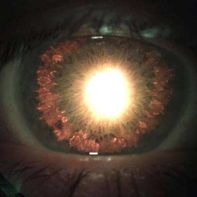 Read more about the article Pigment dispersion syndrome and pigmentary glaucoma: the basics