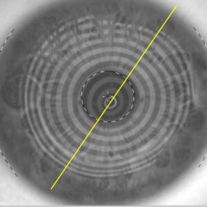 Read more about the article When the cornea is not routine: finding the right refraction in patients with keratoconus
