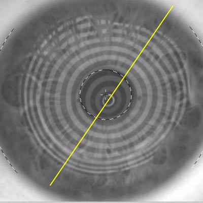 Read more about the article When the cornea is not routine: finding the right refraction in patients with keratoconus