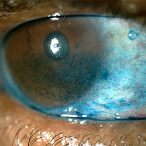 Read more about the article Ocular surface considerations for (and from) different subspecialties