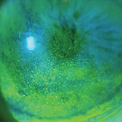 Read more about the article The tear film’s optical power