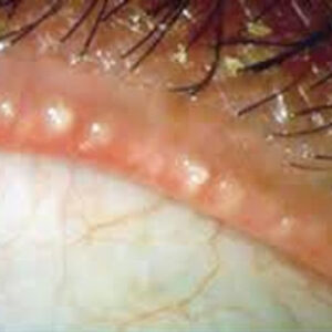 Read more about the article Identifying different types of dry eye