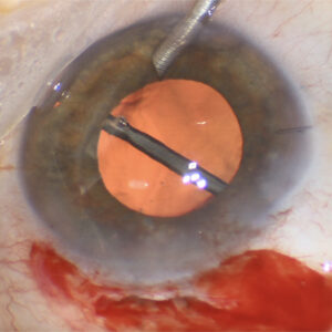 Read more about the article Pars plana anterior vitrectomy: an evolving practice