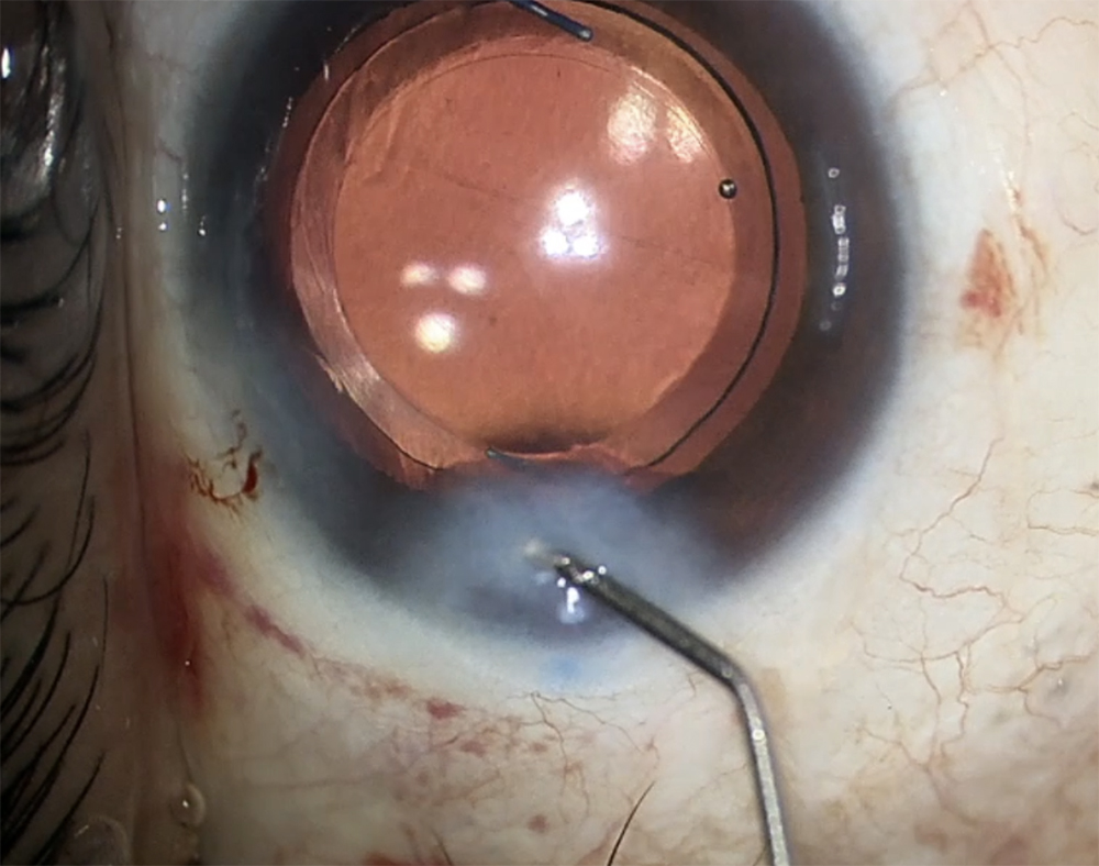 Hydration of Wong pocket with balanced salt solution