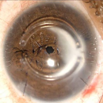 Read more about the article Dealing with a non-routine cornea: irregular astigmatism and a potential solution