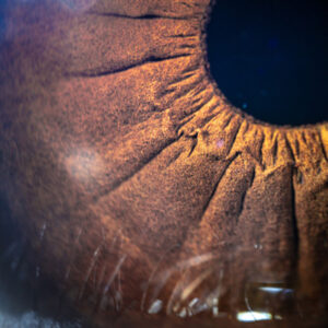 Read more about the article Study finds diabetic donor tissue effective in corneal transplant surgeries