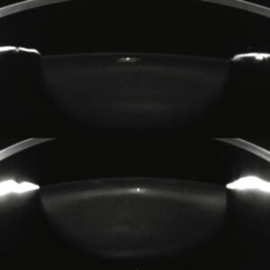 Read more about the article Dysfunctional lens syndrome: opening doors to earlier and customized interventions