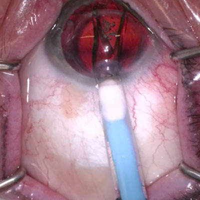 Read more about the article Using the ICL as a supplementary IOL