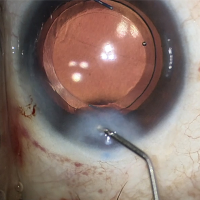 Read more about the article Incisions in cataract surgery