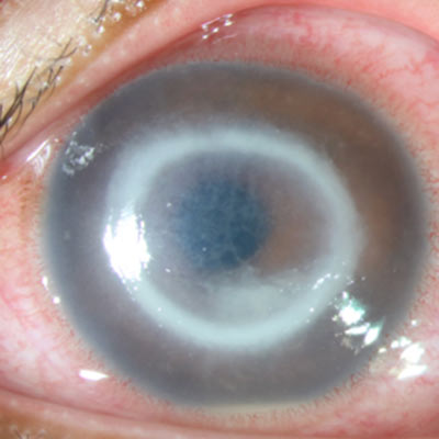 Read more about the article Looking out for atypical cornea infections