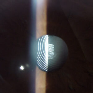 Read more about the article Unlocking patient satisfaction after presbyopia-correcting IOLs