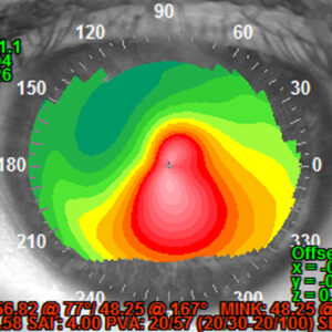 Read more about the article Irregular astigmatism: what we’re missing—and how to find it