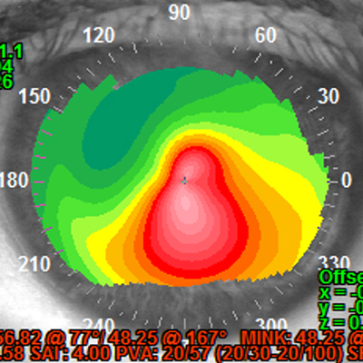 Read more about the article Irregular astigmatism: what we’re missing—and how to find it
