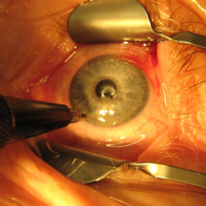 Read more about the article Options for managing astigmatism in cataract surgery