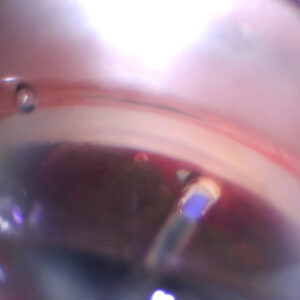 Read more about the article Expanding options in the suprachoroidal space