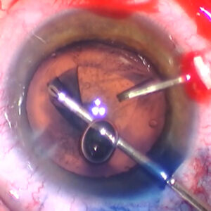 Read more about the article Zonulopathy: signs and surgical management