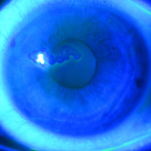 Read more about the article Treatment options for EBMD and recurrent corneal erosions